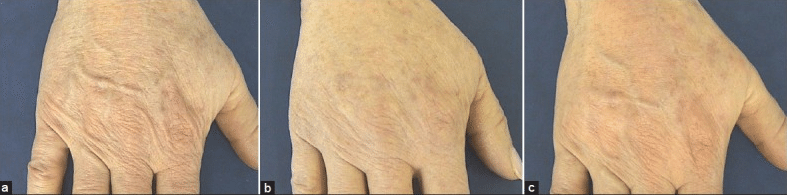 Radiesse-Hidroxiapatita de calcio-Preenchimento-Maos-Dermatologista-Belo Horizonte-BH
